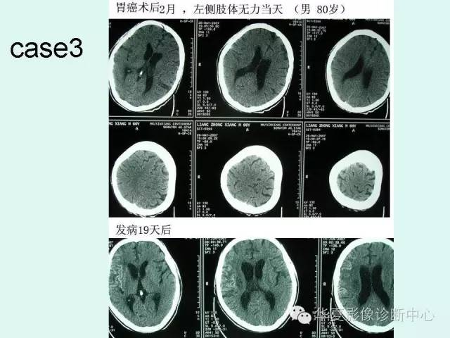 【PPT】脑皮质层状坏死的影像表现