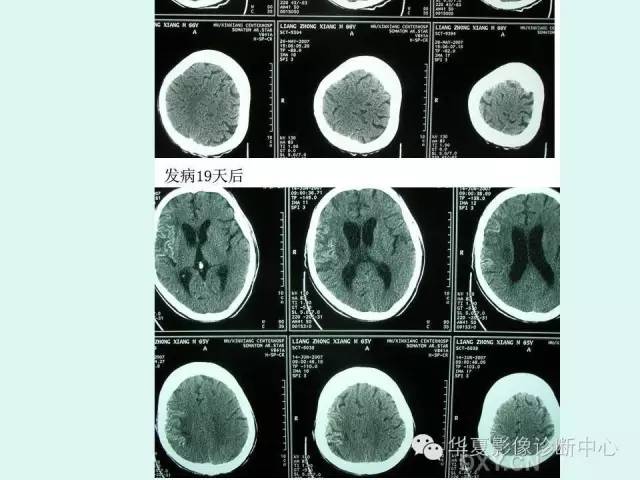 【PPT】脑皮质层状坏死的影像表现