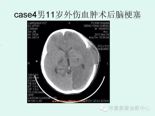 【PPT】脑皮质层状坏死的影像表现