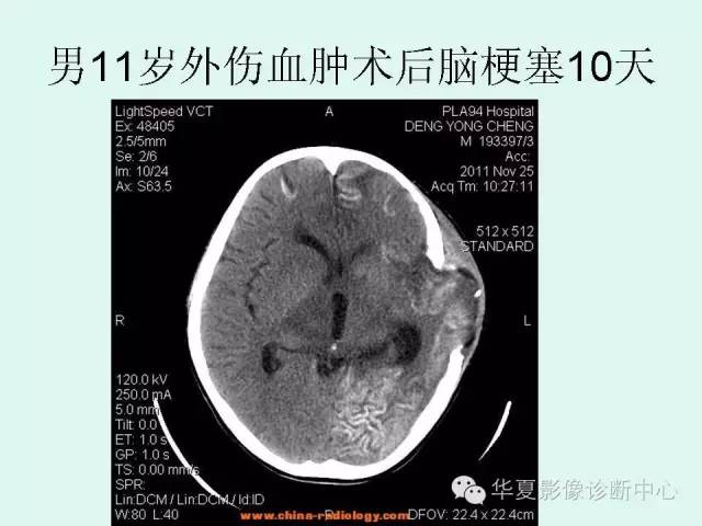 【PPT】脑皮质层状坏死的影像表现