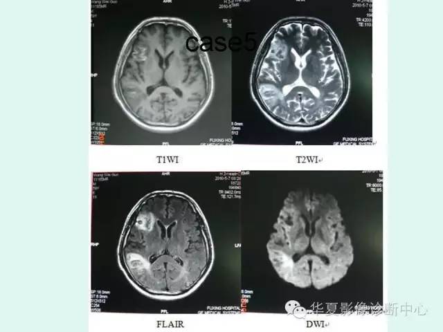【PPT】脑皮质层状坏死的影像表现