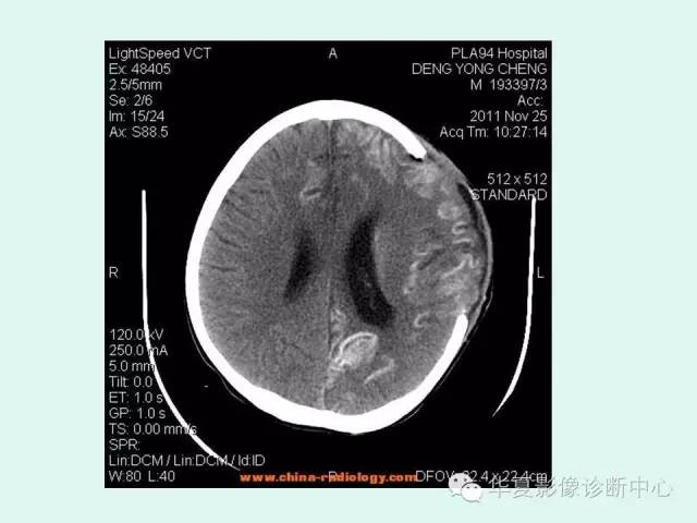 【PPT】脑皮质层状坏死的影像表现