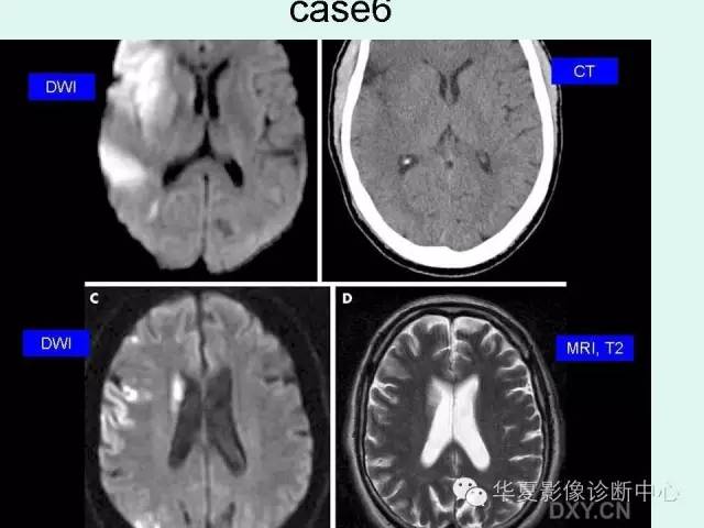 【PPT】脑皮质层状坏死的影像表现