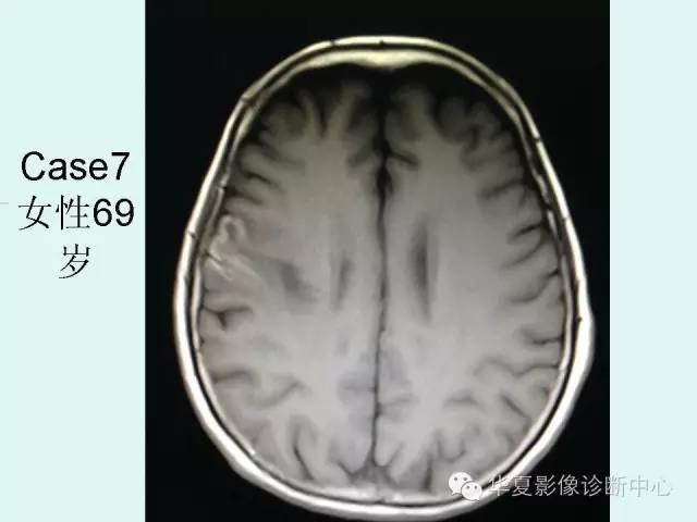 【PPT】脑皮质层状坏死的影像表现