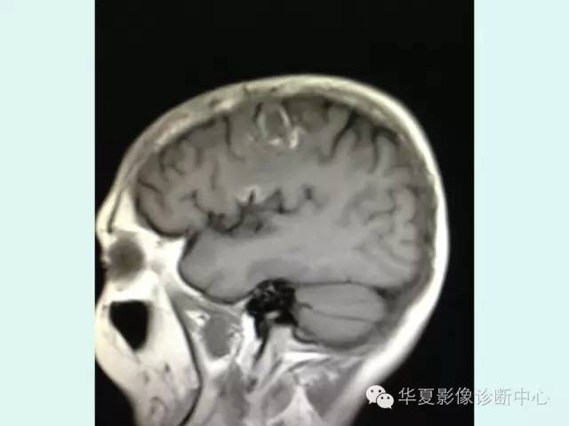 【PPT】脑皮质层状坏死的影像表现