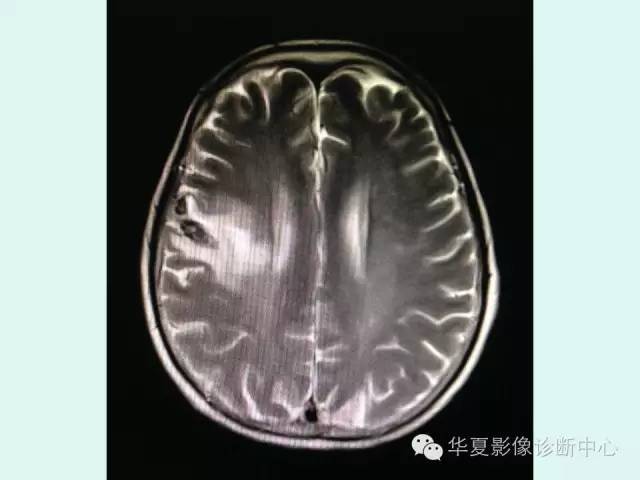 【PPT】脑皮质层状坏死的影像表现