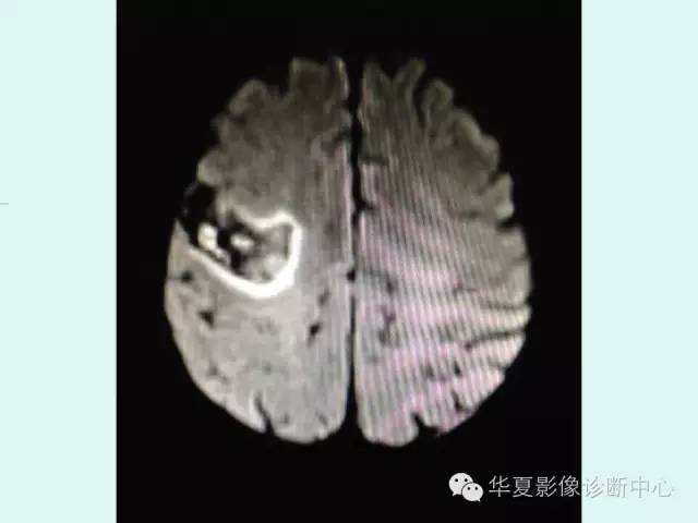 【PPT】脑皮质层状坏死的影像表现