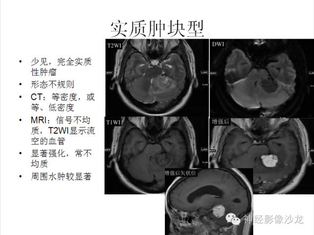 【病例】小脑血管母细胞瘤1例CT及MR影像表现