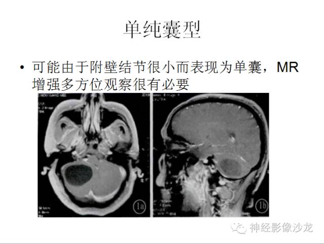【病例】小脑血管母细胞瘤1例CT及MR影像表现