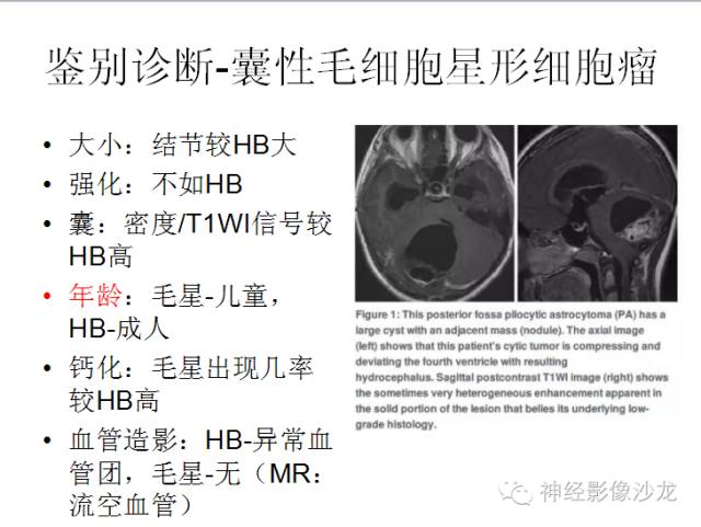 【病例】小脑血管母细胞瘤1例CT及MR影像表现