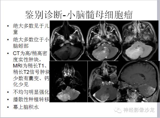 【病例】小脑血管母细胞瘤1例CT及MR影像表现
