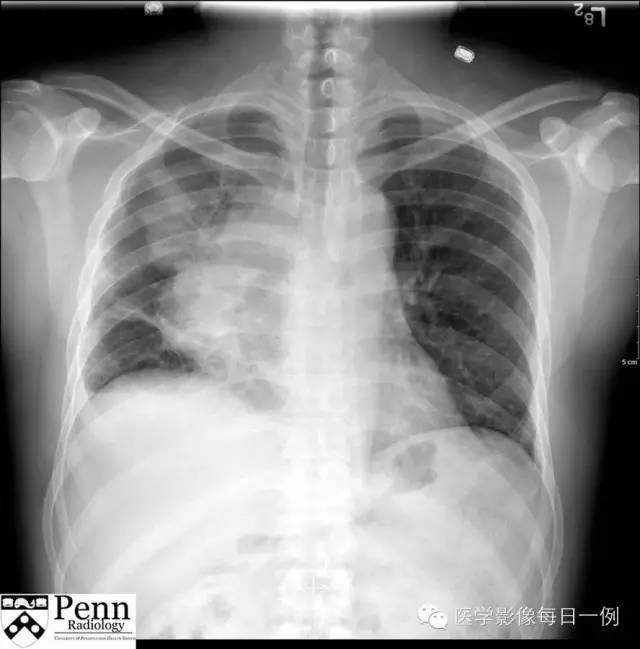 【病例】纵膈精原细胞瘤1例CT影像表现 【病例】纵膈精原细胞瘤1例CT影像表现