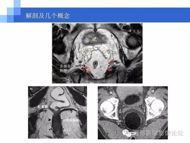 【PPT】3.0T高分辨率MRI在直肠癌分期中的应用及与病理分期对比研究