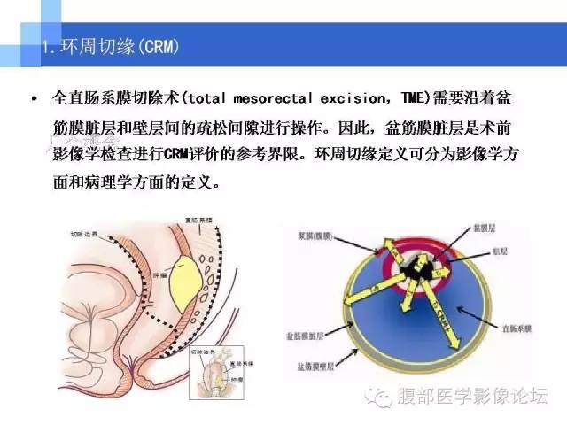 【PPT】3.0T高分辨率MRI在直肠癌分期中的应用及与病理分期对比研究