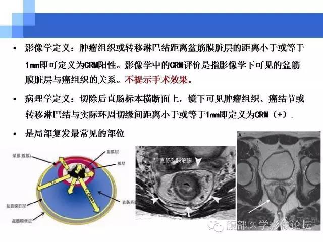【PPT】3.0T高分辨率MRI在直肠癌分期中的应用及与病理分期对比研究