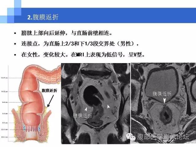 【PPT】3.0T高分辨率MRI在直肠癌分期中的应用及与病理分期对比研究