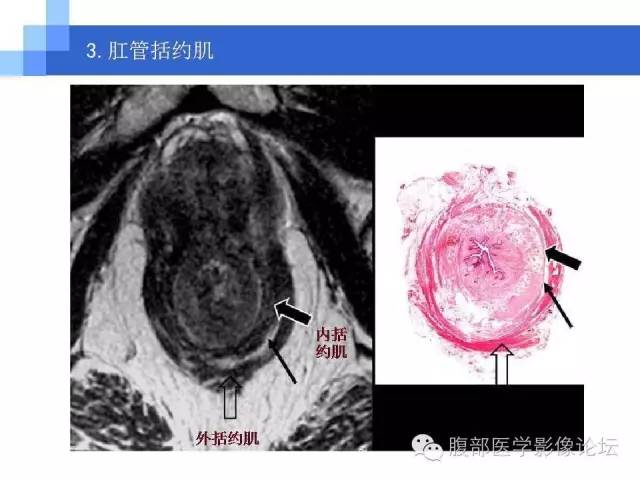 【PPT】3.0T高分辨率MRI在直肠癌分期中的应用及与病理分期对比研究