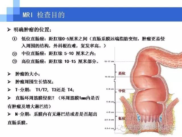 【PPT】3.0T高分辨率MRI在直肠癌分期中的应用及与病理分期对比研究