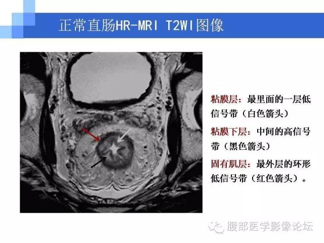 【PPT】3.0T高分辨率MRI在直肠癌分期中的应用及与病理分期对比研究
