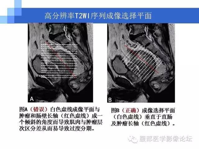 【PPT】3.0T高分辨率MRI在直肠癌分期中的应用及与病理分期对比研究