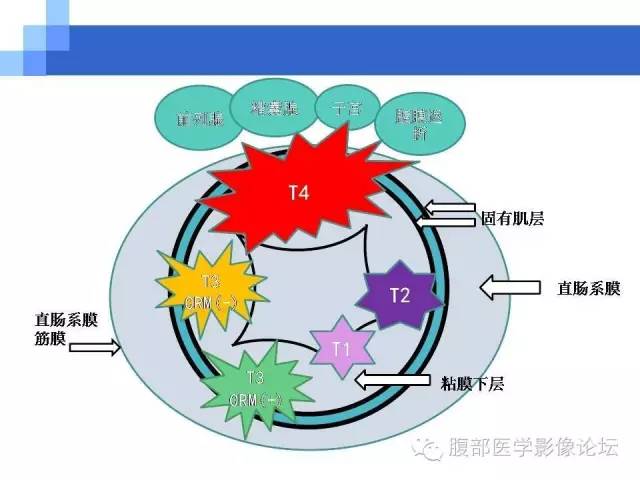 【PPT】3.0T高分辨率MRI在直肠癌分期中的应用及与病理分期对比研究