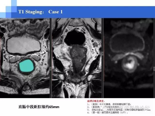 【PPT】3.0T高分辨率MRI在直肠癌分期中的应用及与病理分期对比研究
