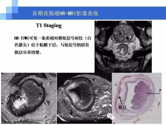 【PPT】3.0T高分辨率MRI在直肠癌分期中的应用及与病理分期对比研究