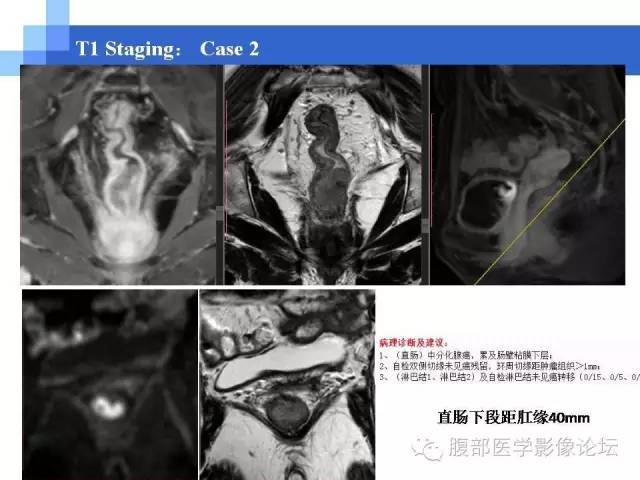 【PPT】3.0T高分辨率MRI在直肠癌分期中的应用及与病理分期对比研究