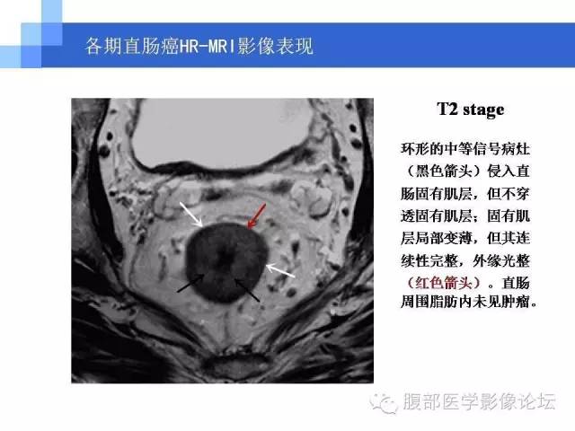 【PPT】3.0T高分辨率MRI在直肠癌分期中的应用及与病理分期对比研究