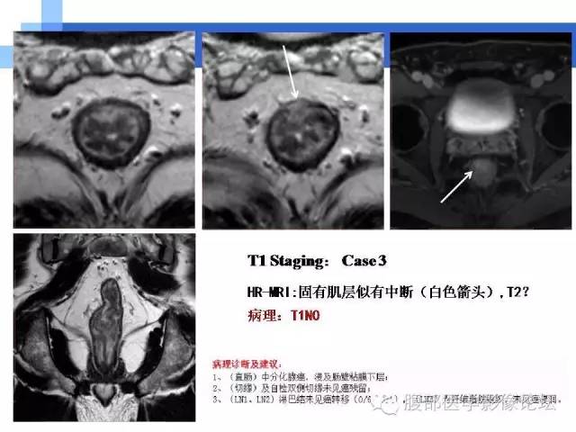 【PPT】3.0T高分辨率MRI在直肠癌分期中的应用及与病理分期对比研究