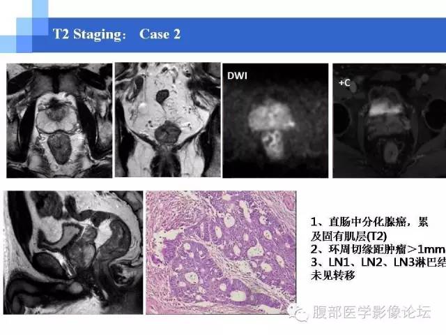 【PPT】3.0T高分辨率MRI在直肠癌分期中的应用及与病理分期对比研究