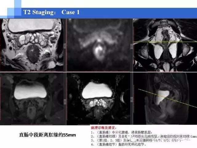 【PPT】3.0T高分辨率MRI在直肠癌分期中的应用及与病理分期对比研究