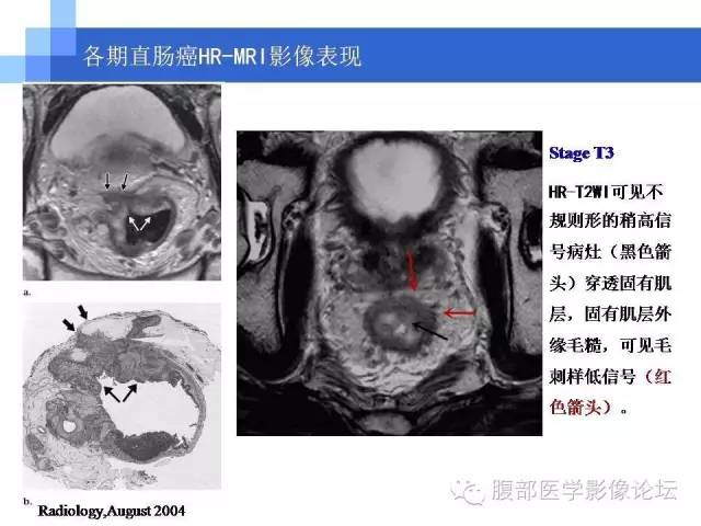 【PPT】3.0T高分辨率MRI在直肠癌分期中的应用及与病理分期对比研究