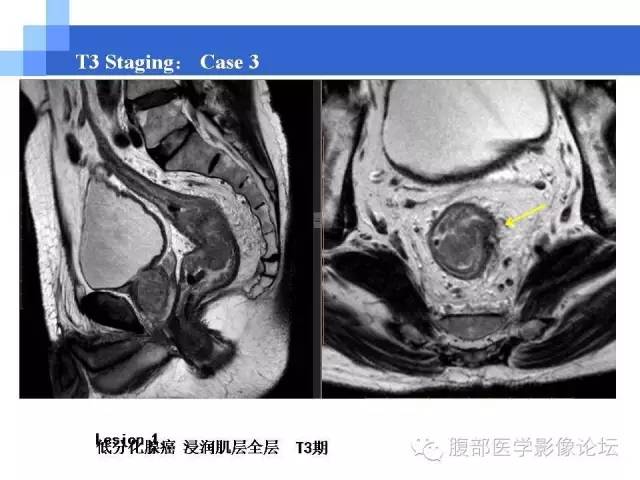 【PPT】3.0T高分辨率MRI在直肠癌分期中的应用及与病理分期对比研究