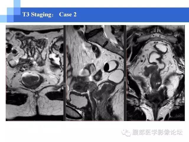 【PPT】3.0T高分辨率MRI在直肠癌分期中的应用及与病理分期对比研究