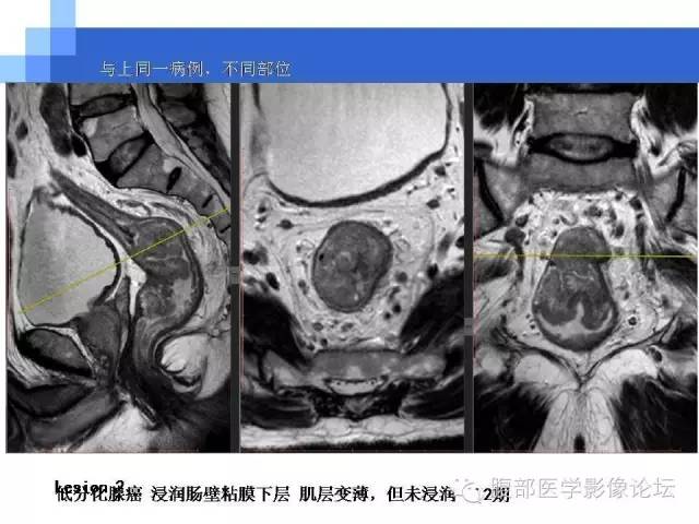 【PPT】3.0T高分辨率MRI在直肠癌分期中的应用及与病理分期对比研究
