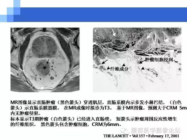【PPT】3.0T高分辨率MRI在直肠癌分期中的应用及与病理分期对比研究