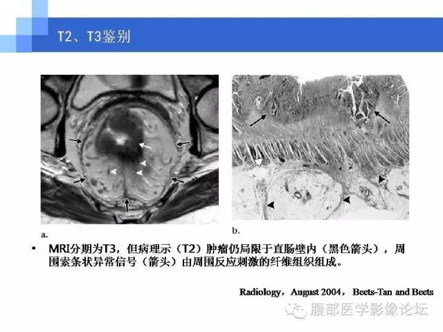 【PPT】3.0T高分辨率MRI在直肠癌分期中的应用及与病理分期对比研究