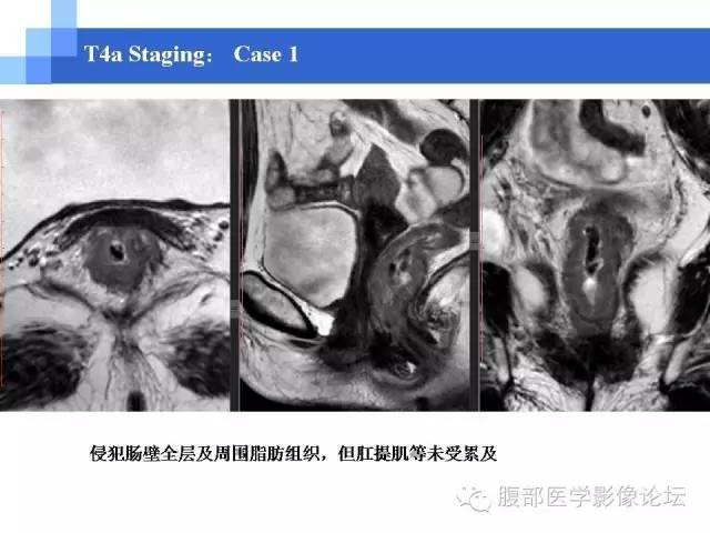 【PPT】3.0T高分辨率MRI在直肠癌分期中的应用及与病理分期对比研究