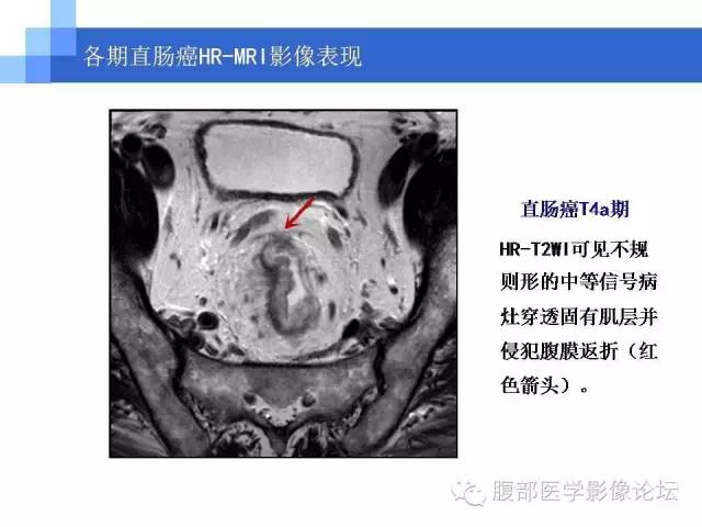 【PPT】3.0T高分辨率MRI在直肠癌分期中的应用及与病理分期对比研究
