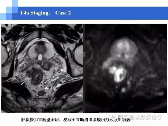 【PPT】3.0T高分辨率MRI在直肠癌分期中的应用及与病理分期对比研究