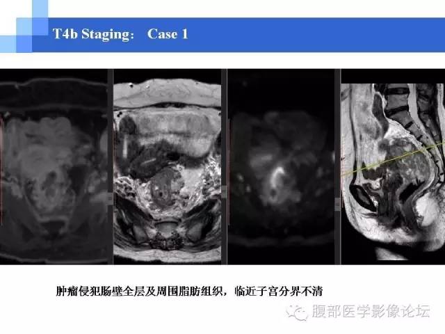 【PPT】3.0T高分辨率MRI在直肠癌分期中的应用及与病理分期对比研究