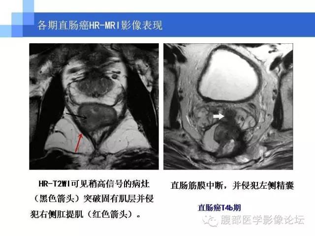 【PPT】3.0T高分辨率MRI在直肠癌分期中的应用及与病理分期对比研究