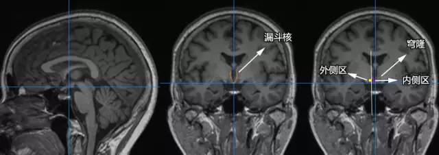 六步十图认识下丘脑,361度无死角 六步十图认识下丘脑,361度无死角