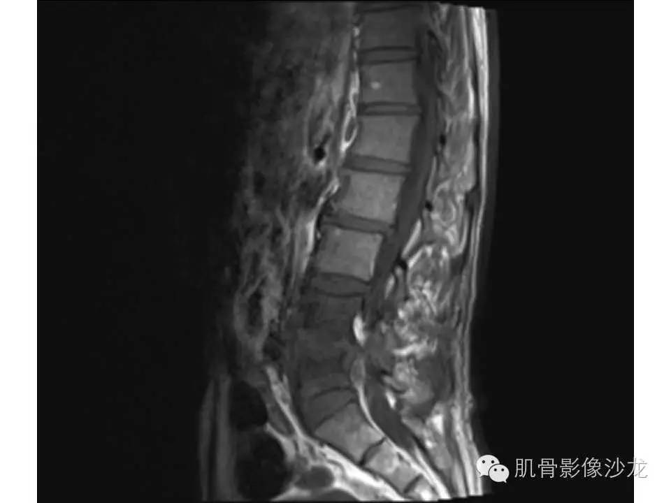 【病例】布氏杆菌脊柱炎1例MR影像讨论 【病例】布氏杆菌脊柱炎1例MR影像讨论