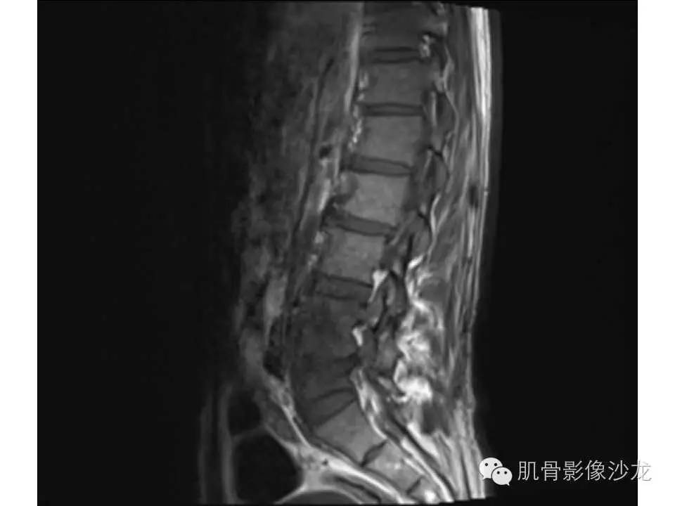 【病例】布氏杆菌脊柱炎1例MR影像讨论