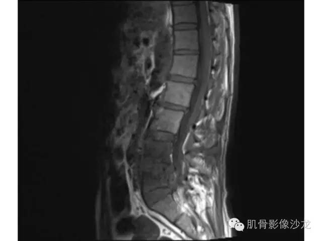 【病例】布氏杆菌脊柱炎1例MR影像讨论 【病例】布氏杆菌脊柱炎1例MR影像讨论