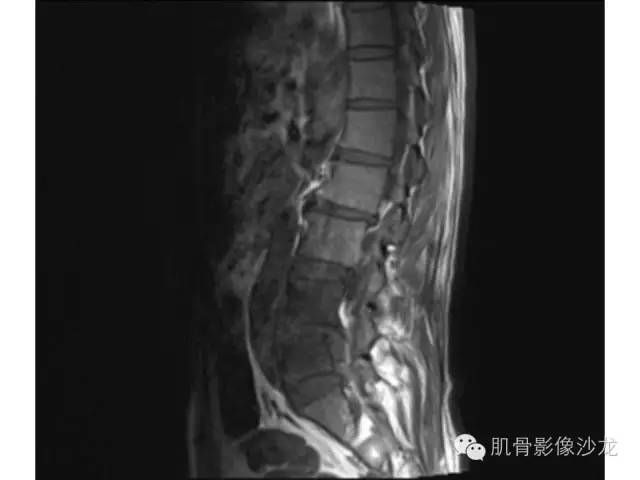 【病例】布氏杆菌脊柱炎1例MR影像讨论 【病例】布氏杆菌脊柱炎1例MR影像讨论