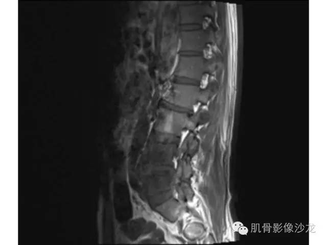【病例】布氏杆菌脊柱炎1例MR影像讨论 【病例】布氏杆菌脊柱炎1例MR影像讨论
