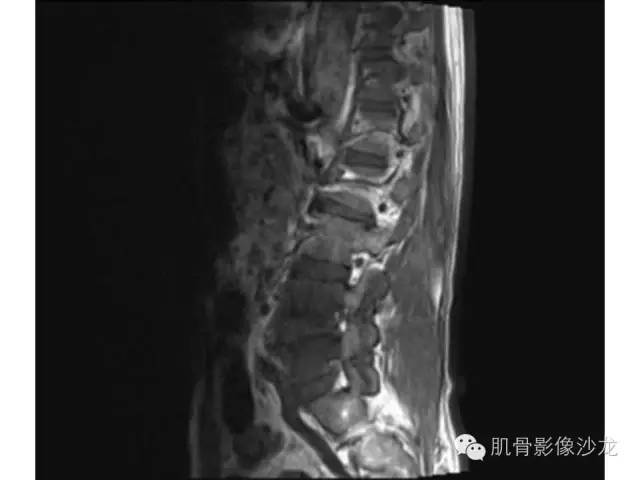【病例】布氏杆菌脊柱炎1例MR影像讨论 【病例】布氏杆菌脊柱炎1例MR影像讨论